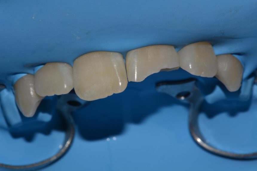 Ricostruzione in composito a mano libera - Studio dentistico Rho Dental